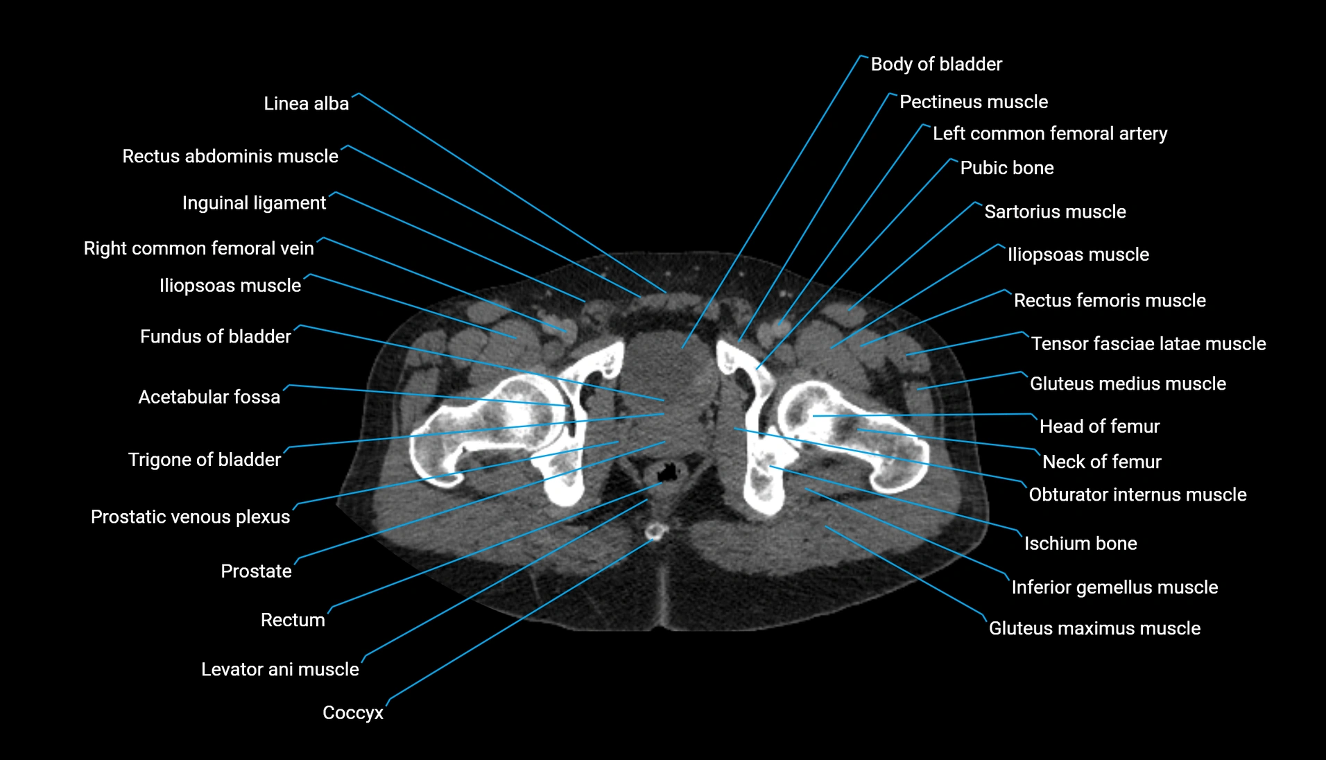 CT urogram axial cross sectional anatomy  labelled radiology image-00243.webp
